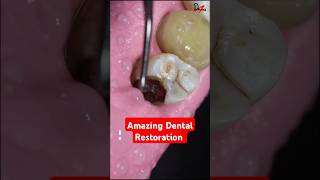 Dental Restoration of a Massive Decay asmr rct dentalcrowns [upl. by Soisatsana]