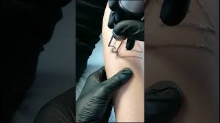 indepartare tatuaj laser [upl. by Ettereve681]