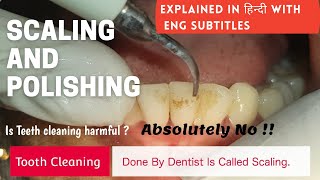 How Scaling is done   Teeth cleaning  Scaling and Polishing [upl. by Nawoj]