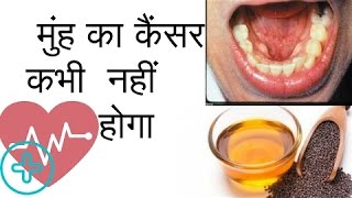 Muh Ke Cancer Ka Ilaj  मुंह का कैंसर  Mouth Cancer Symptoms in Hindi [upl. by Kinna472]