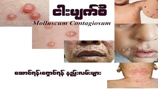 ငါးမျက်စိ Molluscum Contagiosum [upl. by Aretina]