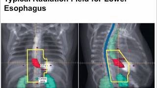 esophagus cancer radiation [upl. by Innep553]