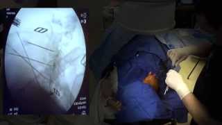 WATCH a Cervical Radiofrequency Ablation  LIVE [upl. by Witkin]