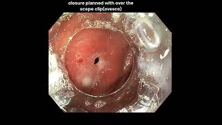 Duodenal perforation Endoscopic closure with ovesco OTSC [upl. by Etak]