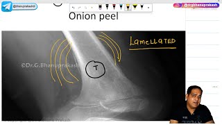 Ewings Sarcoma Hindi  Orthopedics Lecture [upl. by Deaner]