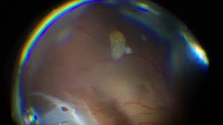 Rhegmatogenous Retinal Detachmenmt Surgery  Vitrecomy with Endolaser with Silicone oil Tampoande [upl. by Idnas788]