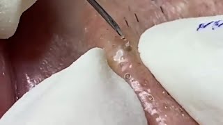 Painstaking Super Satisfying Pimple Relaxing Skincare [upl. by Gotthelf264]