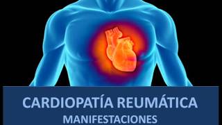 Cardiopatía reumática  Manifestaciones [upl. by Meier70]