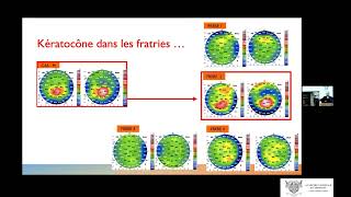 Réhabilitation chirurgicale du kératocone  Surgical rehabilitation of Keratoconus [upl. by Bernadina]