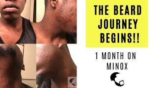 Growing a Beard With Minoxidil A Black Mans Experience 1 Month In [upl. by Eaves]