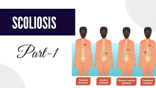 SCOLIOSIS  PART1  COBBS ANGLE  DEXTRO SCOLIOSIS  LEVO SCOLIOSIS  TREATMENT OF SCOLIOSIS [upl. by Gobert790]