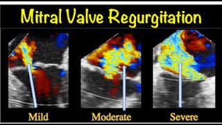 Mitral valve regurgitation  How to Diagnose Mitral Regurgitation [upl. by Avi777]