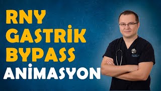 RNY Gastrik Bypass animasyon  Op Dr Fakı AKIN [upl. by Kilan]