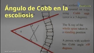 Ángulo de Cobb en la escoliosis [upl. by Yemaj]