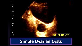 Understanding Simple Ovarian Cysts Ultrasound Findings  Ovarian Cyst  Simple follicular cyst [upl. by Gnuhp]