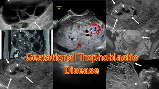 Radiology Viva Case  01  Gestational Trophoblastic disease  Molar pregnancy medical radiology [upl. by Airres]