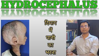 Hydrocephalus A killer disease Hindi  Symptoms amp surgeries  Dr Manish Mishra  Neurosurgeon [upl. by Seely]