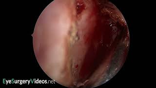 Posteriorly located frontal processlacrimal bone suture line [upl. by Aiekam441]