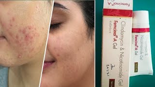 Femcinol A Gel review  Femcinol A Skin Gel  7 दिन मे फर्क पिंपल के दाग भी चले जाते है femcinol a [upl. by Latyrc643]