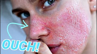 How to Tell if Your Skin Barrier is Damaged [upl. by Grose361]