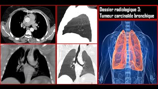 Dossier radiologique 3Tumeur carcinoïde bronchique [upl. by Bruce11]