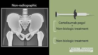 A OneYear PlaceboControlled Study in NonRadiographic Axial Spondyloarthritis [upl. by Novahs718]