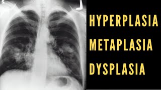 Hyperplasia Metaplasia amp Dysplasia Explained Cancer Biology [upl. by Moth850]