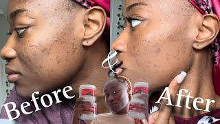 My Journey With Hormonal and Stress Acne [upl. by Silas]