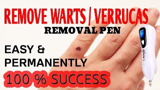 How To Remove Wart Permanently 100 Success Best Way To Remove Wart Amithpj Business And Leisure [upl. by Kitrak]