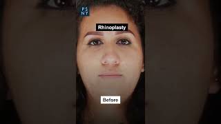 Discover the transformative power of rhinoplasty [upl. by Gnouc]