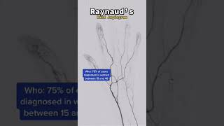 What is Raynauds Syndrome pt 1 [upl. by Zorina210]