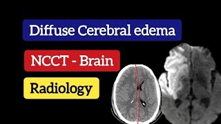 Diffuse Cerebral edema  CT Brain  Radiology [upl. by Lidia912]