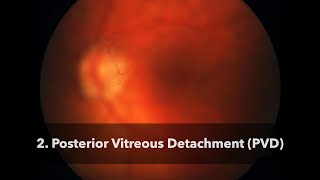 2 Posterior Vitreous Detachment PVD [upl. by Ardnued]