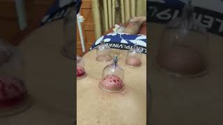 hijama therapy veiwvirlshort humanbodyacupressure hijamacupping hijamatreatment hijamacenter [upl. by Omoj]