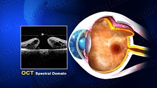 Foro maculare terapia chirurgica wwwoculisticaTVit [upl. by Cave254]