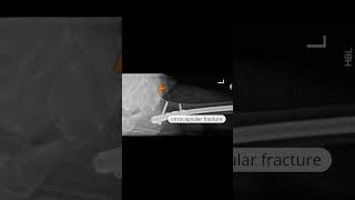 Intramedullary femoral nail with subcapital neck of femur fracture shoets [upl. by Rodoeht273]