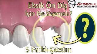 Ön Diş Eksikliği için 5 farklı Çözüm Tedavi  Diş Çekimi Sonrası Ne Yapmalı [upl. by Ynetsed789]