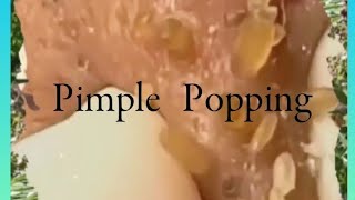 Pimple amp Blackheads Popping  38 [upl. by Lisab743]