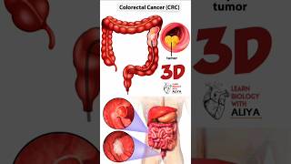 Colorectal Cancer Treatment  animation 3d short  learn Biology with Aliya [upl. by Mcripley]