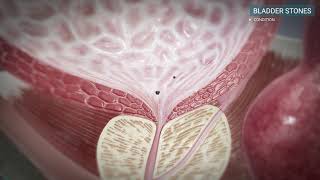 Urology Bladder stones [upl. by Pare599]