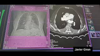 AngioTac de arterias pulmonares con Bolus Tracking en ventriculo Derecho AngioTep Angiotc [upl. by Akiv]