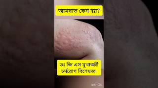 Allergy Urticaria Itching Skin rash Dr G S Mukherjee dermatologist allergy skinspecialist [upl. by Yerac107]