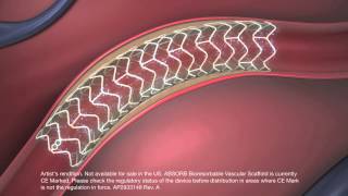 Dissolving stent restores blood flow to heart [upl. by Sadnac760]