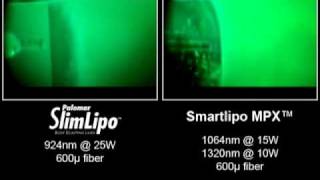 Video of Laser Liposuction Comparing SlimLipo vs SmartLipo and Lipotherme [upl. by Enela]