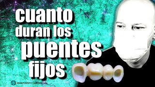 🔵PROBLEMAS con los PUENTES FIJOS sin IMPLANTES [upl. by Eimyaj106]