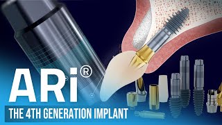 ARi  The 4th Generation Implant [upl. by Lolande]