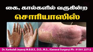 PALMOPLANTAR PSORIASIS  கை கால்களில் சொரியாசிஸ்  JKT SKIN psoriasis treatment medicine [upl. by Annaya]