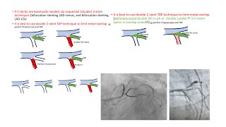 Left main trifurcation strategies [upl. by Yecak]