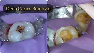 Deep Tooth Decay Removal Procedure  Mandibular Molar Caries Removal Process [upl. by Arbuckle]