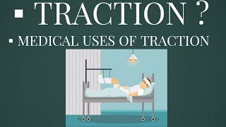 What is Traction  Medical Uses of traction [upl. by Margi812]